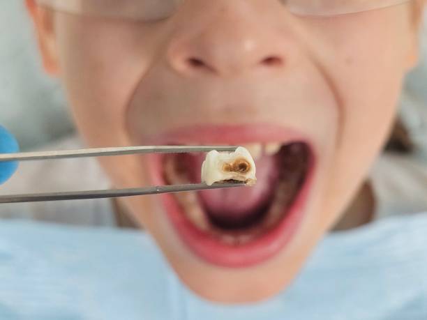 Best Emergency Tooth Extraction in Schulenburg, TX